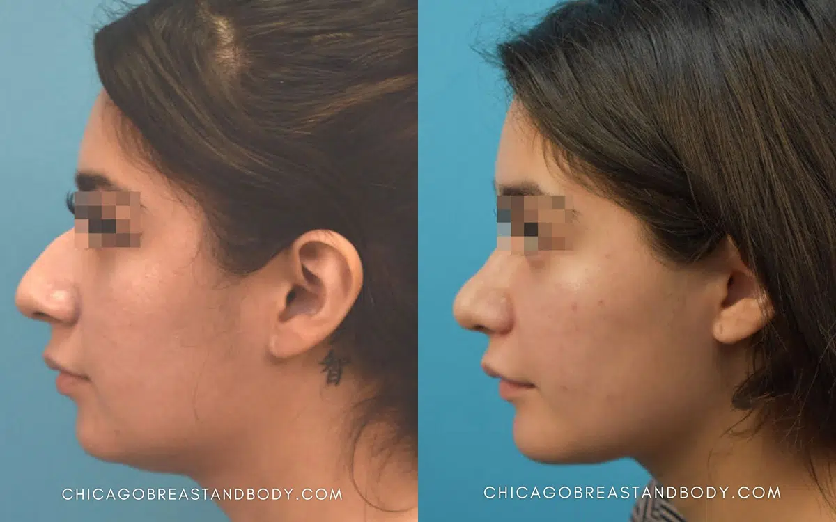 chin augmentation before and after photo by chicago aesthetics surgery & med spa in chicago, il