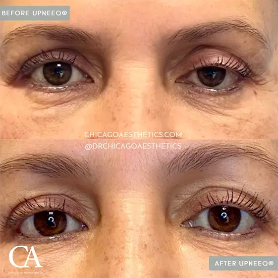Before And After Photos Showcasing The Transformative Effects Of Dermal Fillers On A Patient'S Eyelids.