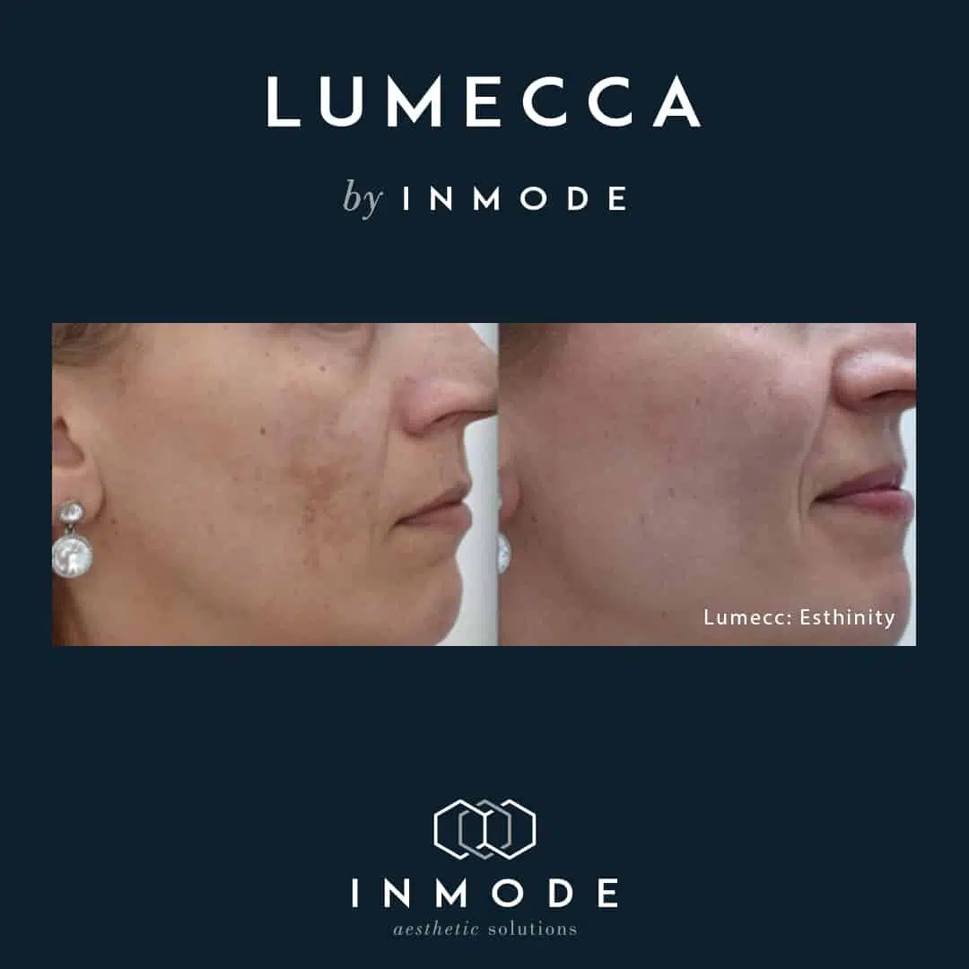 Ipl Lumecca Before And After Chicago Aesthetics Med Spa