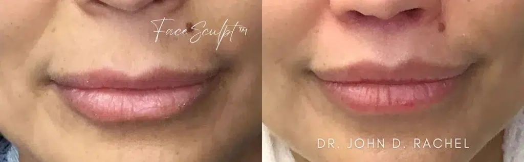 lip lift before and after photo by chicago aesthetics surgery & med spa in chicago, il