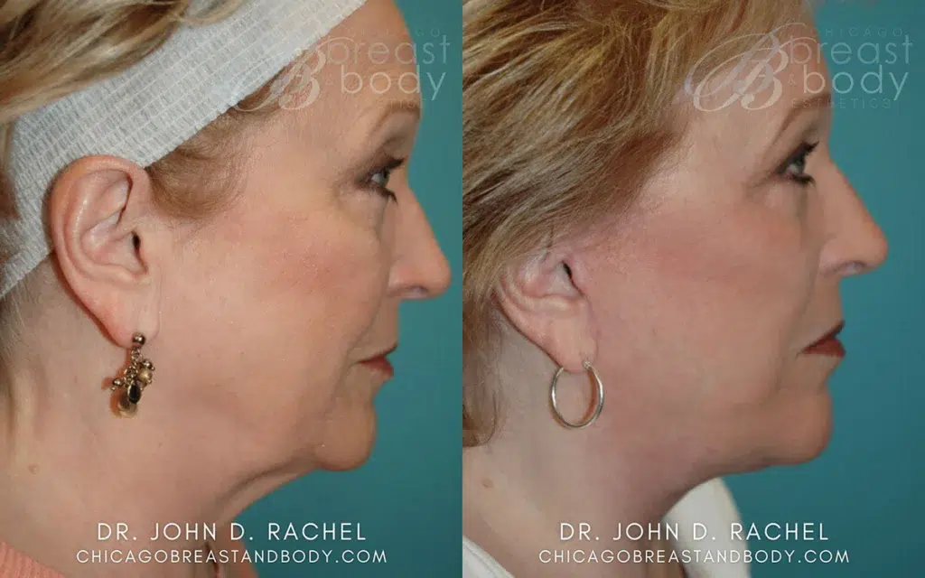 mini facelift before and after photo by chicago aesthetics surgery & med spa in chicago, il