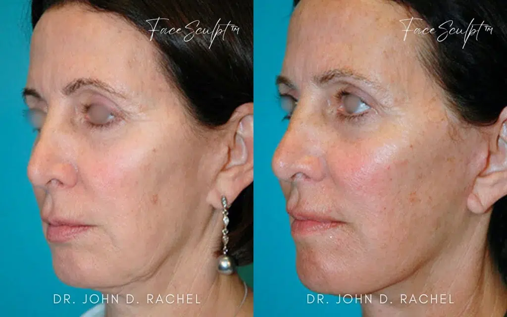 mini facelift before and after photo by chicago aesthetics surgery & med spa in chicago, il