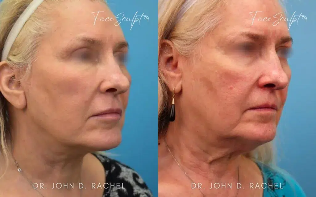 mini facelift before and after photo by chicago aesthetics surgery & med spa in chicago, il