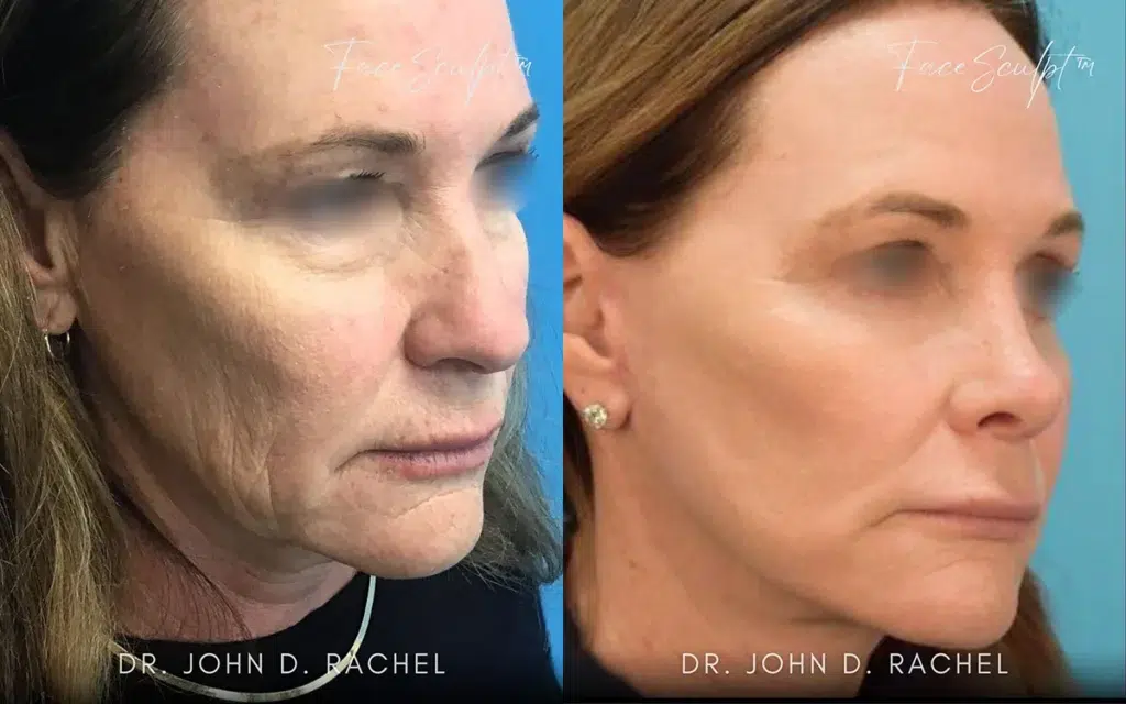 mini facelift before and after photo by chicago aesthetics surgery & med spa in chicago, il