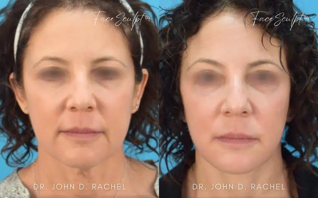 mini facelift before and after photo by chicago aesthetics surgery & med spa in chicago, il