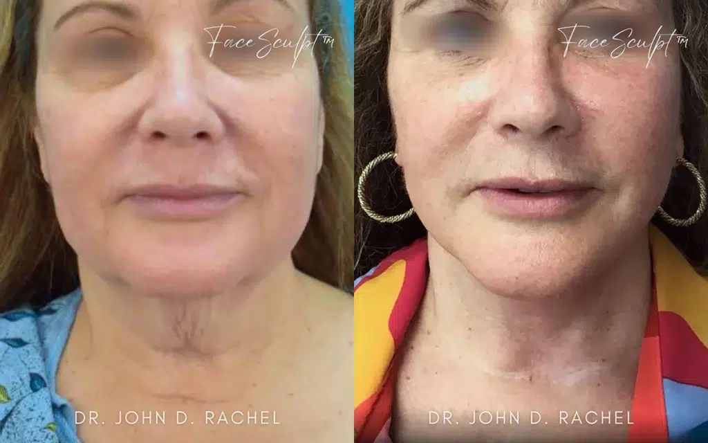 mini facelift before and after photo by chicago aesthetics surgery & med spa in chicago, il