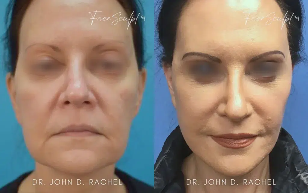 mini facelift before and after photo by chicago aesthetics surgery & med spa in chicago, il