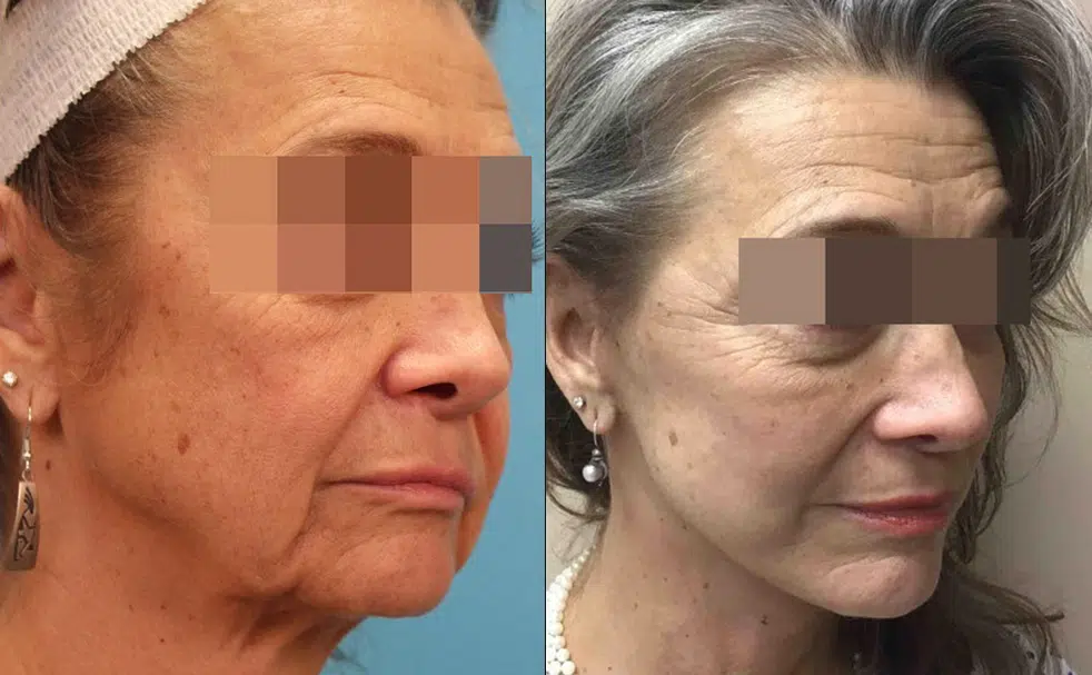 mini facelift before and after photo by chicago aesthetics surgery & med spa in chicago, il