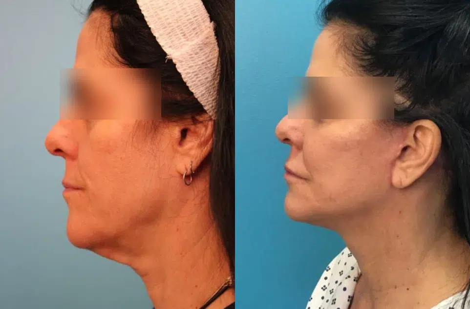 mini facelift before and after photo by chicago aesthetics surgery & med spa in chicago, il