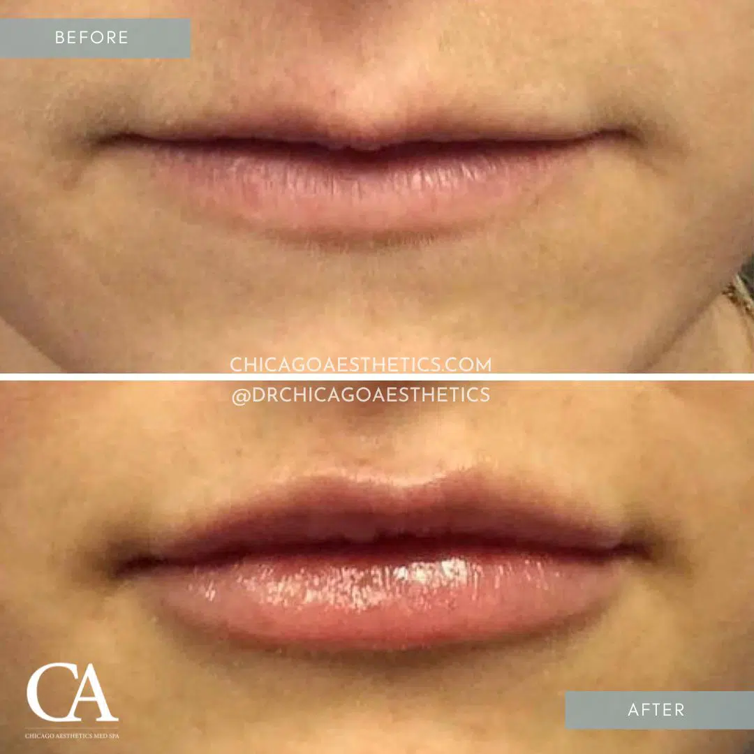 lip filler before after juvederm chicago aesthetics
