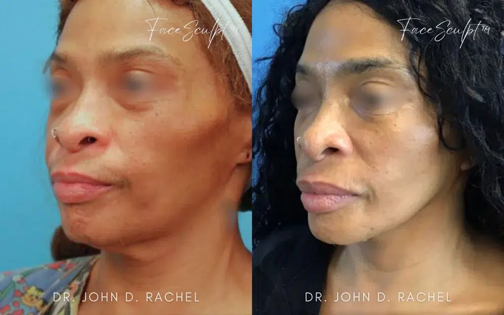 neck lift before and after photo by chicago aesthetics surgery & med spa in chicago, il