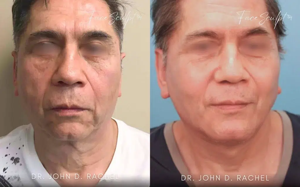 neck lift before and after photo by chicago aesthetics surgery & med spa in chicago, il