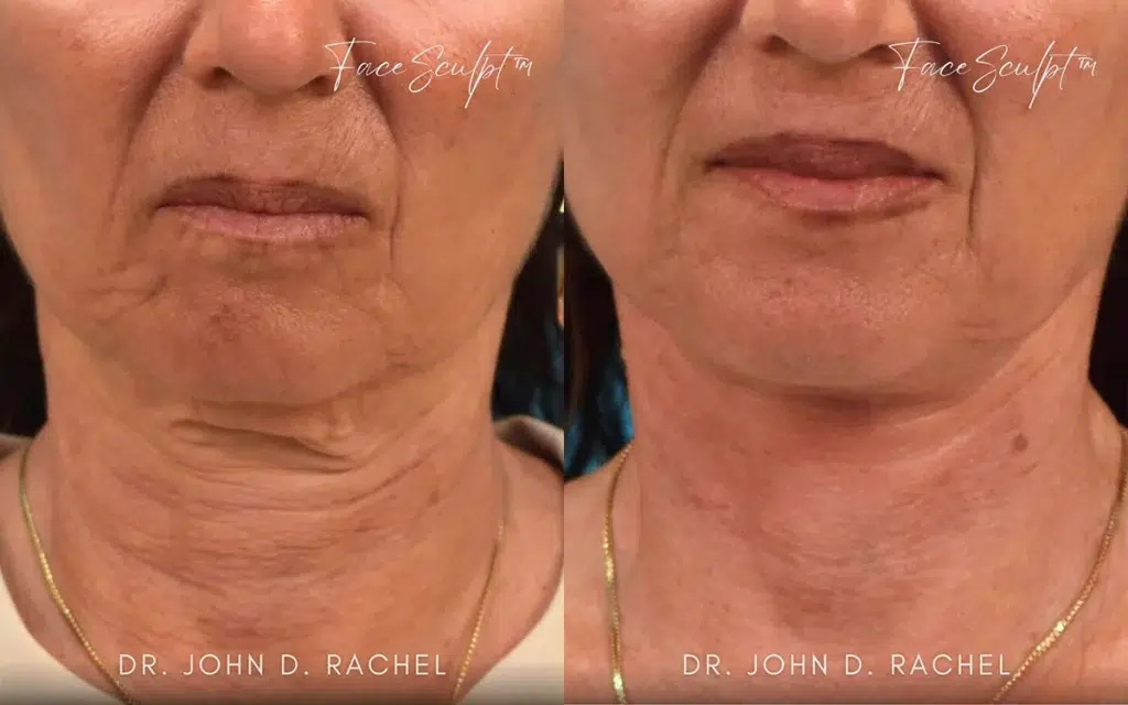 neck lift before and after photo by chicago aesthetics surgery & med spa in chicago, il