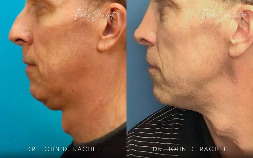 neck lift before and after photo by chicago aesthetics surgery & med spa in chicago, il