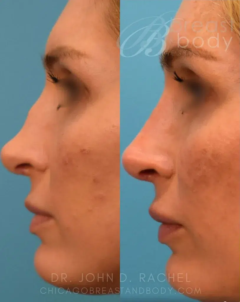 rhinoplasty before and after photo by chicago aesthetics surgery & med spa in chicago, il