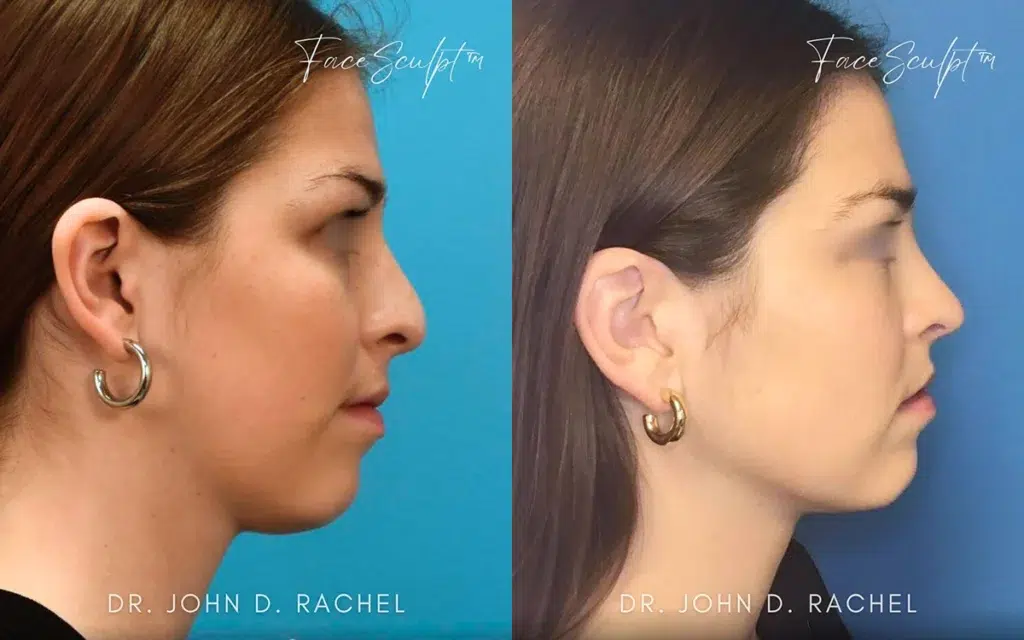 rhinoplasty before and after photo by chicago aesthetics surgery & med spa in chicago, il