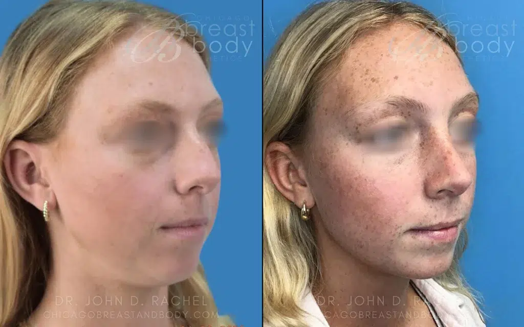 rhinoplasty before and after photo by chicago aesthetics surgery & med spa in chicago, il