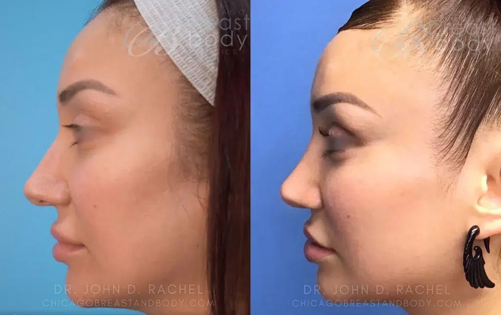 rhinoplasty before and after photo by chicago aesthetics surgery & med spa in chicago, il