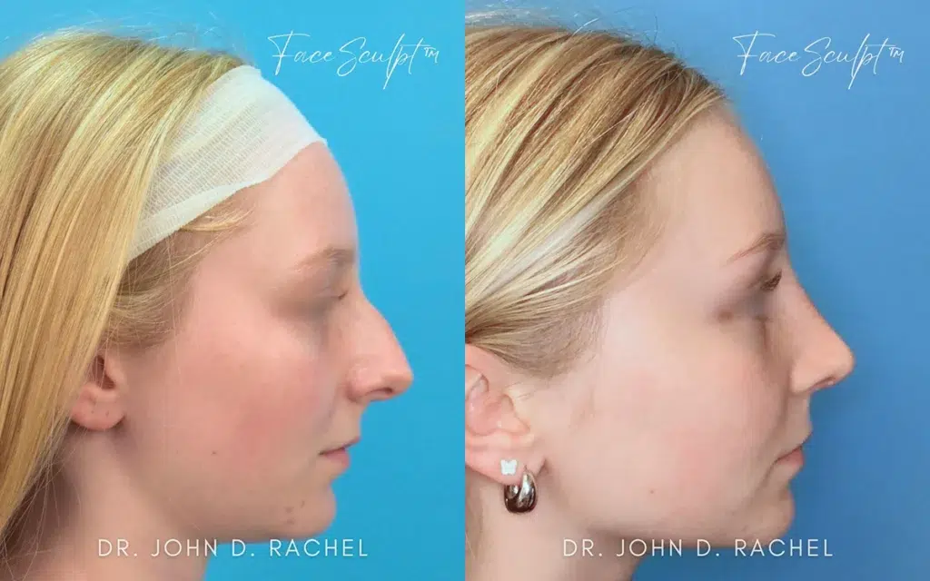 rhinoplasty before and after photo by chicago aesthetics surgery & med spa in chicago, il