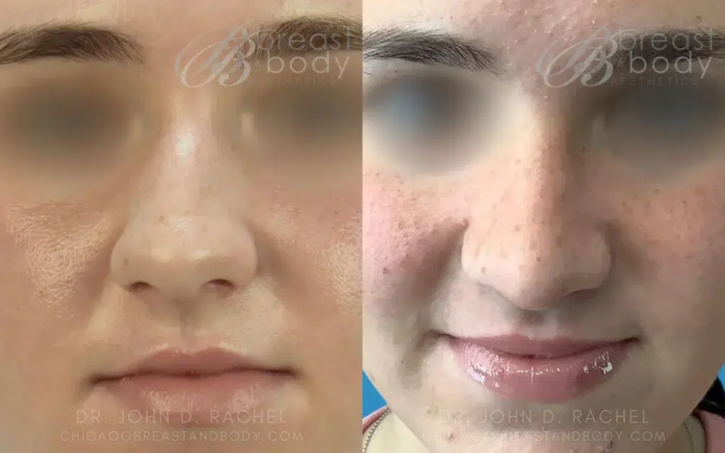 rhinoplasty before and after photo by chicago aesthetics surgery & med spa in chicago, il