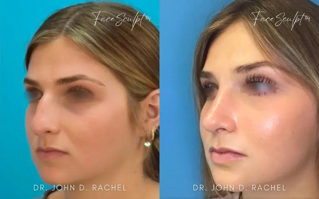 rhinoplasty before and after photo by chicago aesthetics surgery & med spa in chicago, il
