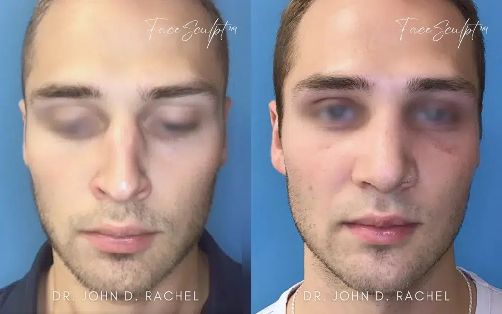 rhinoplasty before and after photo by chicago aesthetics surgery & med spa in chicago, il