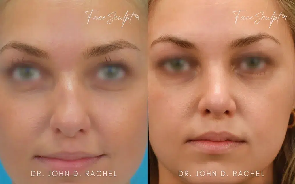 rhinoplasty before and after photo by chicago aesthetics surgery & med spa in chicago, il