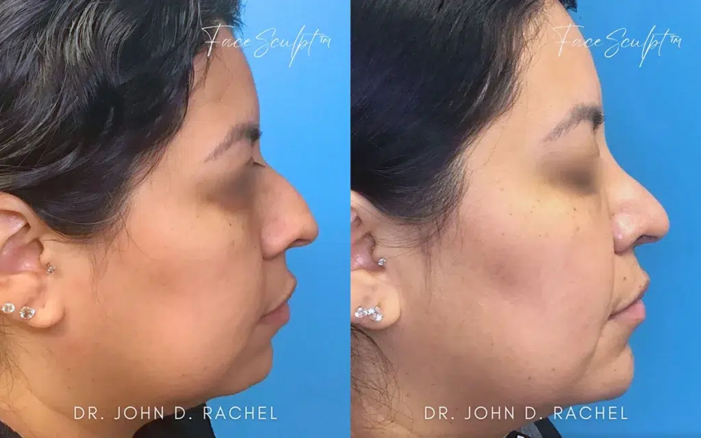 rhinoplasty before and after photo by chicago aesthetics surgery & med spa in chicago, il
