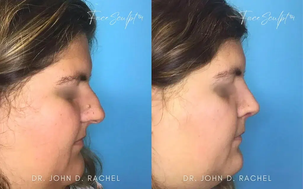 rhinoplasty before and after photo by chicago aesthetics surgery & med spa in chicago, il