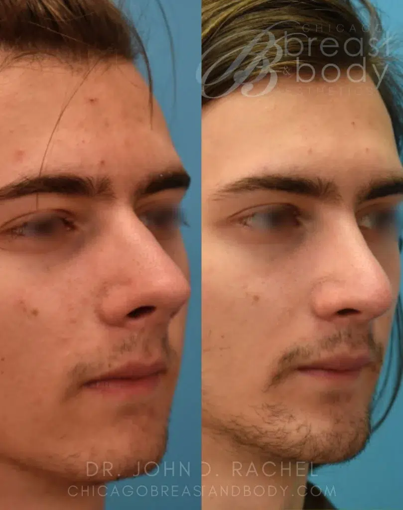rhinoplasty before and after photo by chicago aesthetics surgery & med spa in chicago, il