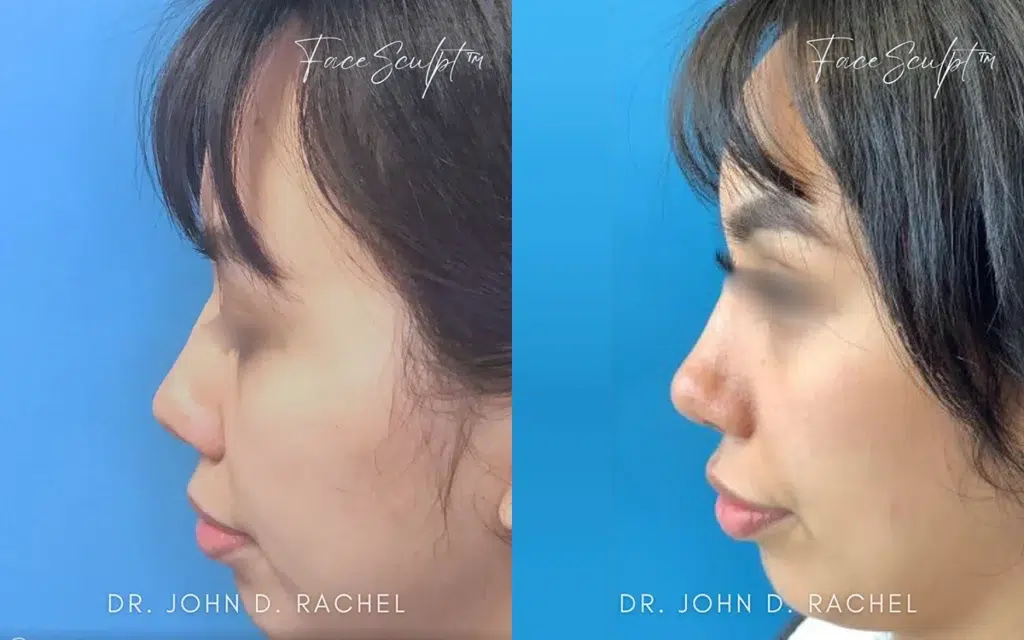 rhinoplasty before and after photo by chicago aesthetics surgery & med spa in chicago, il