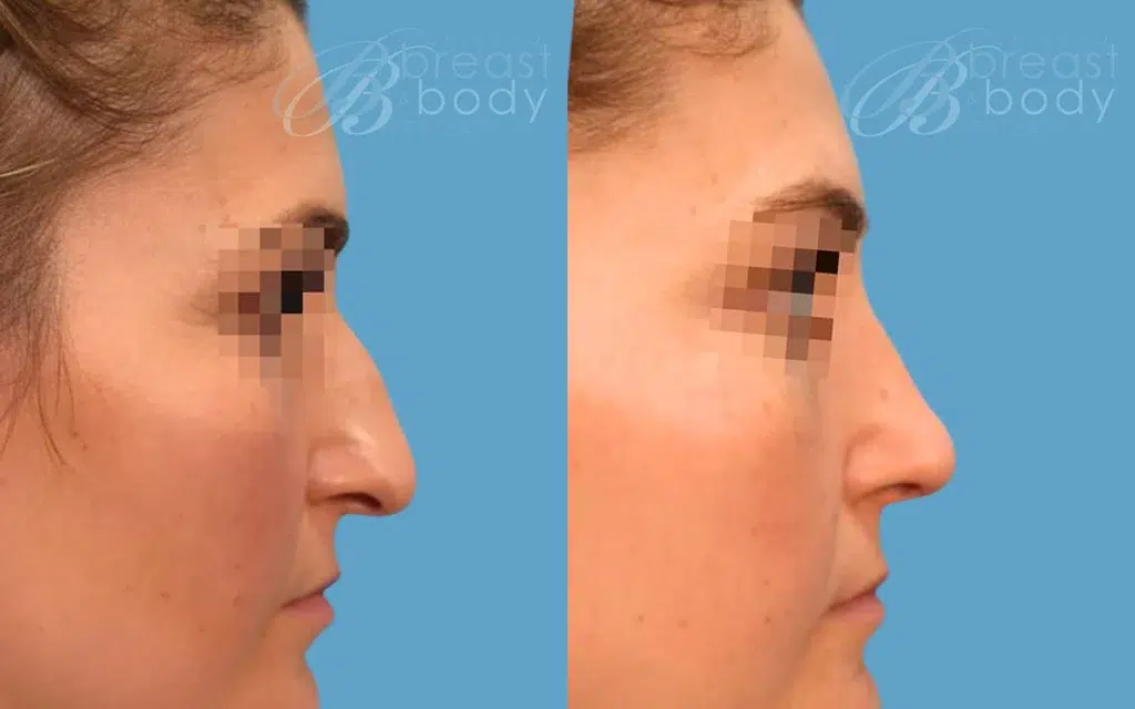 rhinoplasty before and after photo by chicago aesthetics surgery & med spa in chicago, il