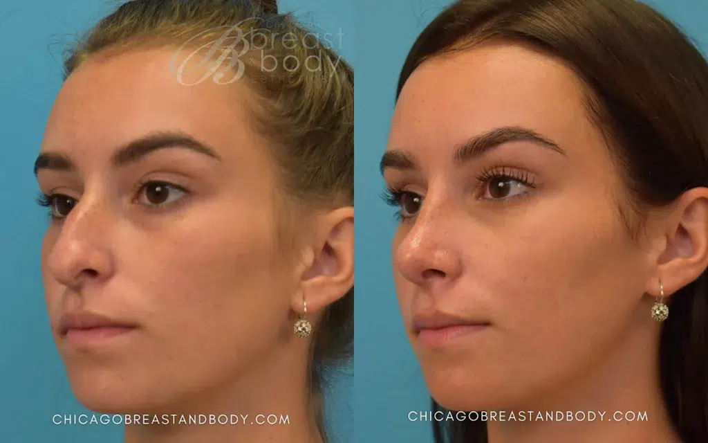 rhinoplasty before and after photo by chicago aesthetics surgery & med spa in chicago, il