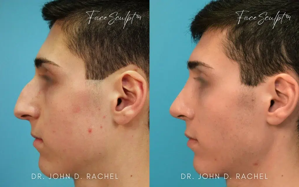 rhinoplasty before and after photo by chicago aesthetics surgery & med spa in chicago, il