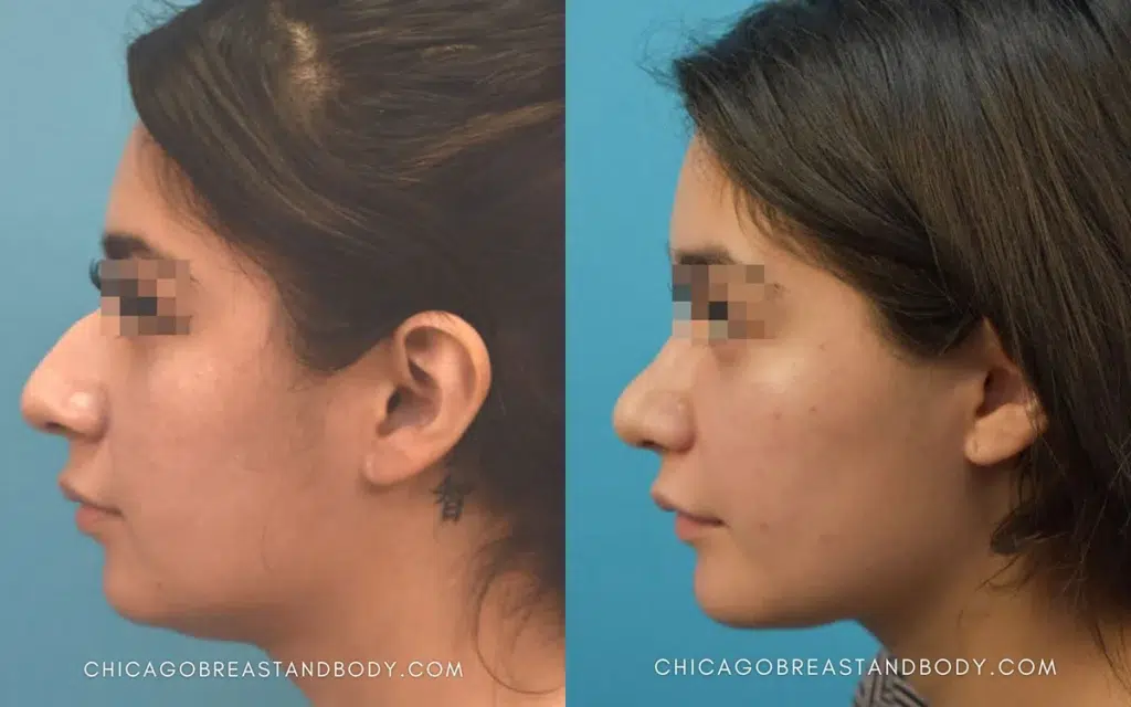 rhinoplasty before and after photo by chicago aesthetics surgery & med spa in chicago, il