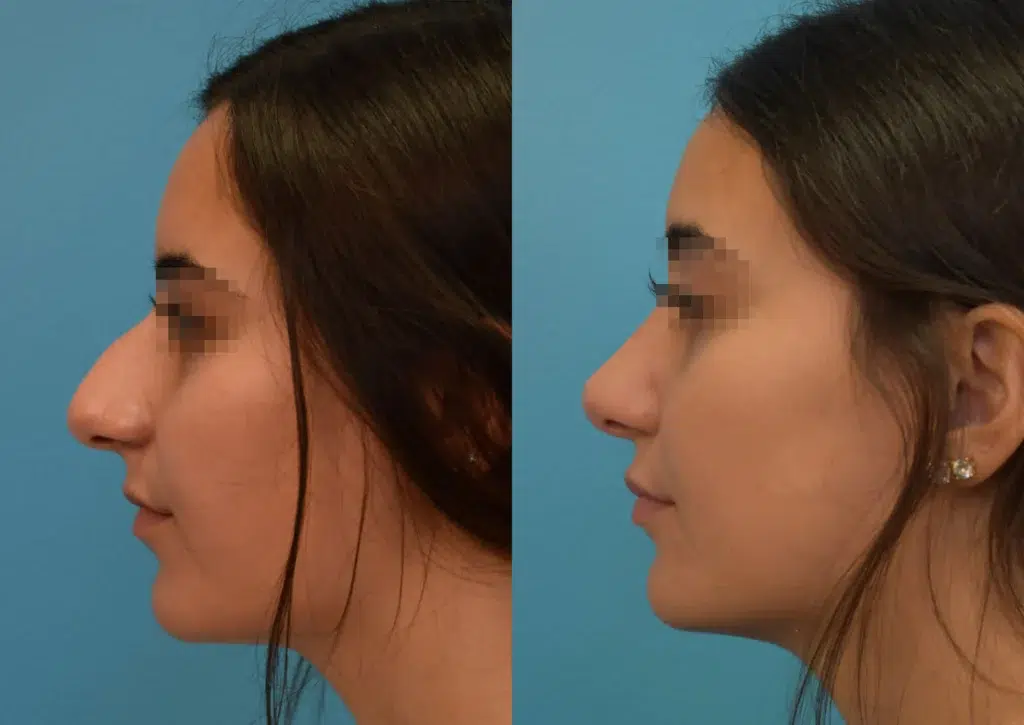 rhinoplasty before and after photo by chicago aesthetics surgery & med spa in chicago, il