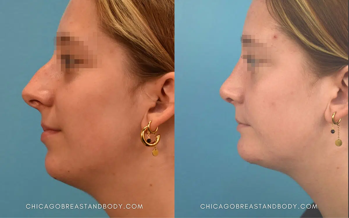rhinoplasty before and after photo by chicago aesthetics surgery & med spa in chicago, il