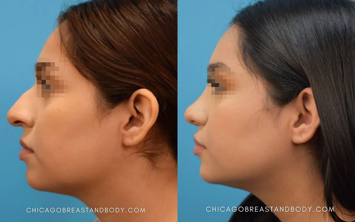 rhinoplasty before and after photo by chicago aesthetics surgery & med spa in chicago, il