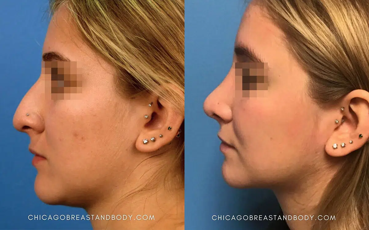 rhinoplasty before and after photo by chicago aesthetics surgery & med spa in chicago, il