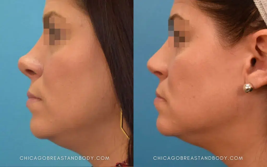 rhinoplasty before and after photo by chicago aesthetics surgery & med spa in chicago, il