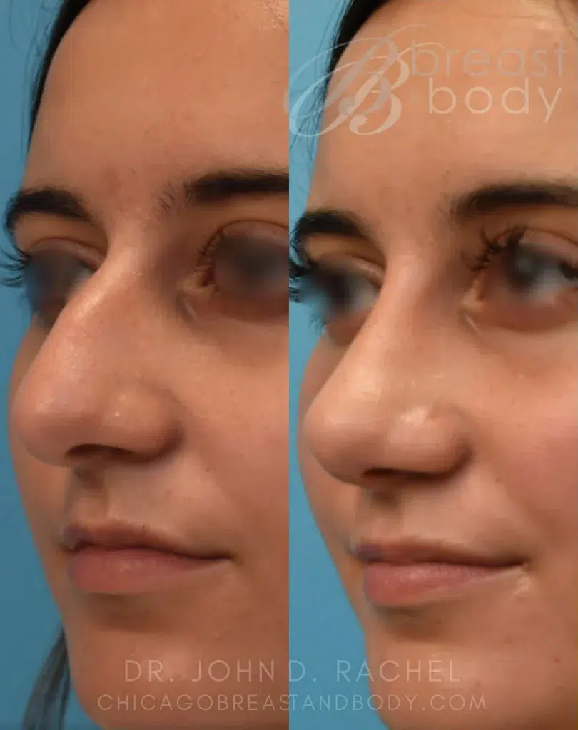 rhinoplasty before and after photo by chicago aesthetics surgery & med spa in chicago, il