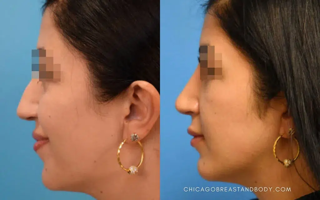 rhinoplasty before and after photo by chicago aesthetics surgery & med spa in chicago, il
