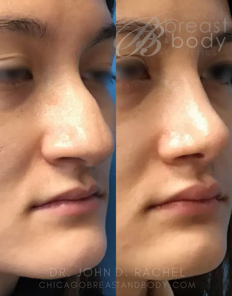rhinoplasty before and after photo by chicago aesthetics surgery & med spa in chicago, il