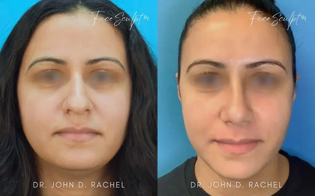 rhinoplasty before and after photo by chicago aesthetics surgery & med spa in chicago, il
