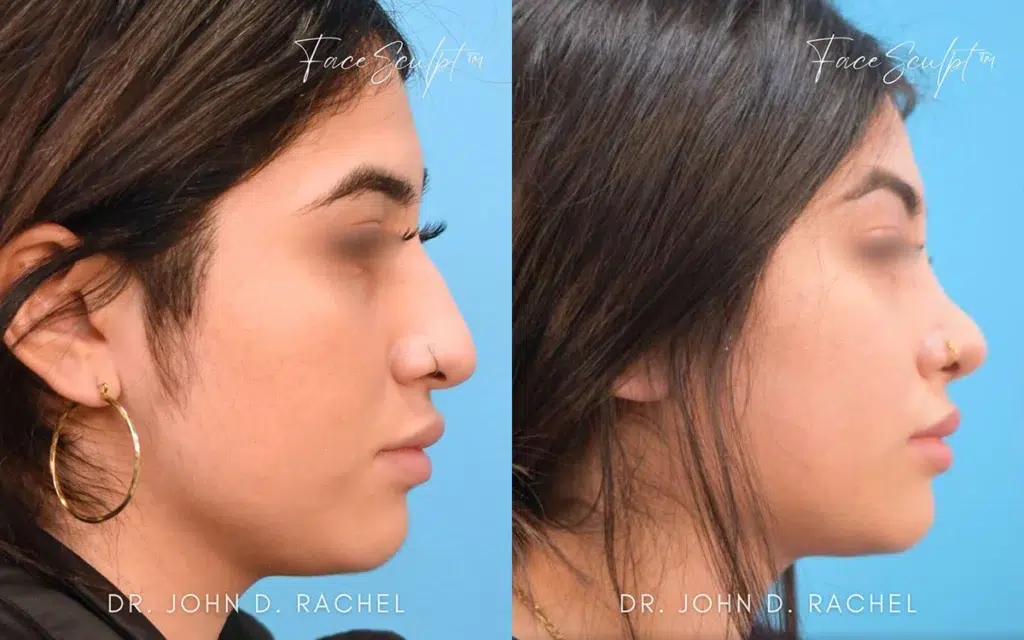 rhinoplasty before and after photo by chicago aesthetics surgery & med spa in chicago, il