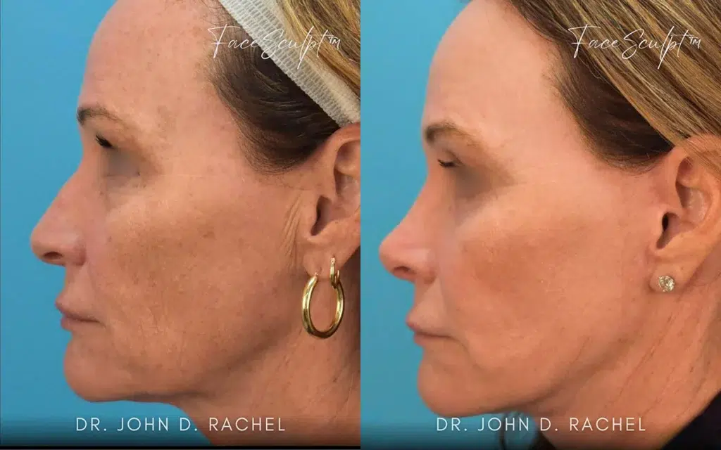 rhinoplasty before and after photo by chicago aesthetics surgery & med spa in chicago, il