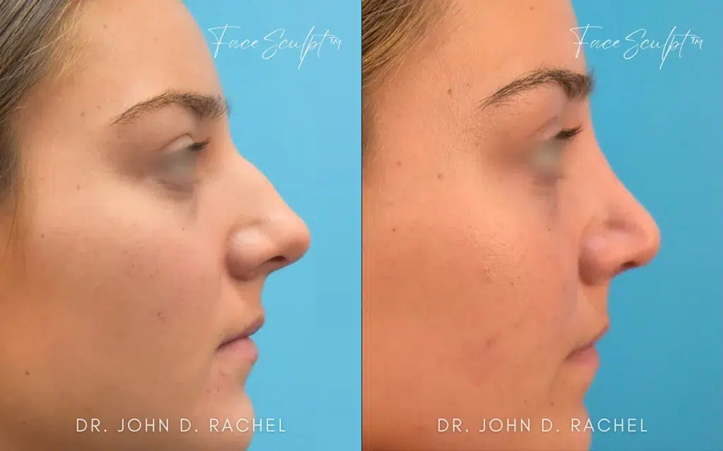 rhinoplasty before and after photo by chicago aesthetics surgery & med spa in chicago, il