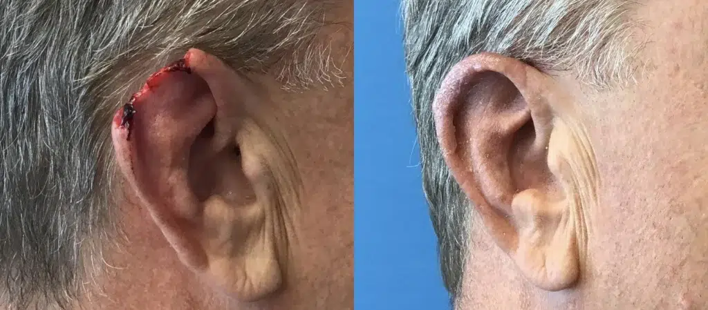 reconstruction before and after photo by chicago aesthetics surgery & med spa in chicago, il