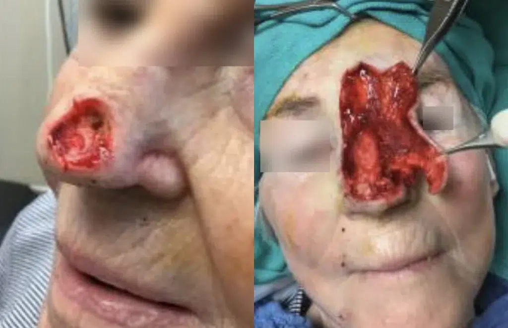 reconstruction before and after photo by chicago aesthetics surgery & med spa in chicago, il