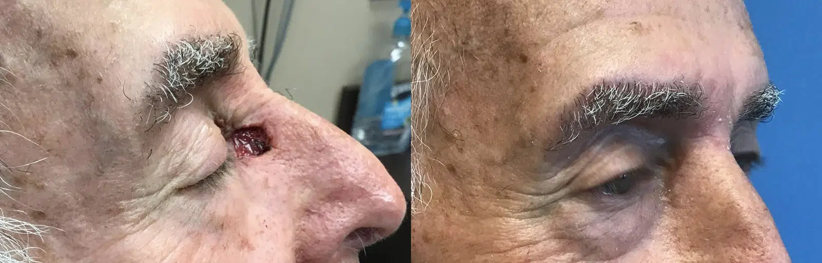 reconstruction before and after photo by chicago aesthetics surgery & med spa in chicago, il